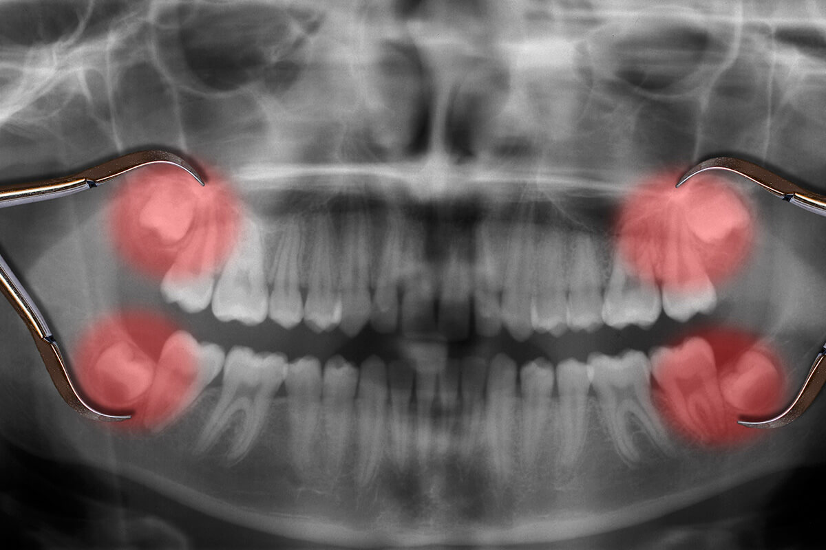 How Painful Is Wisdom Teeth Removal