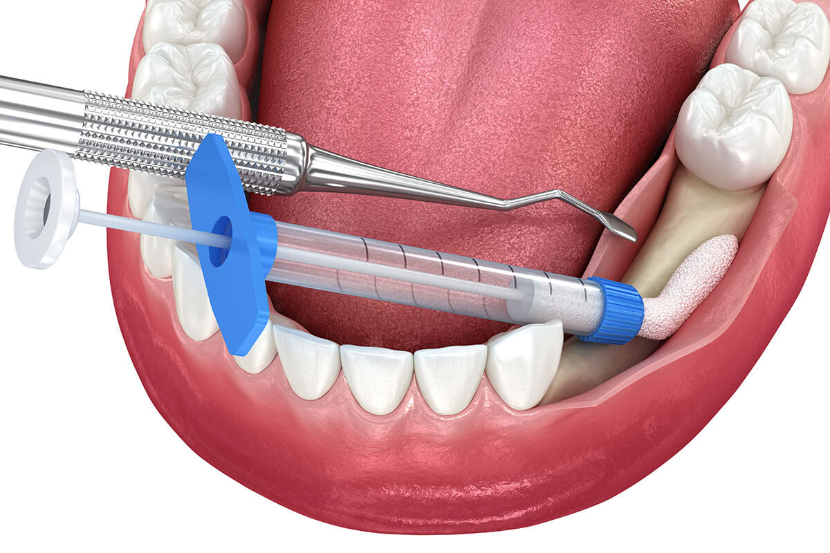 How Much Does Bone Grafting Cost in Albuquerque, NM?