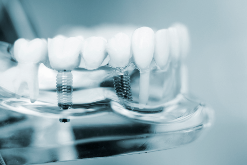 What Is A Full Arch Dental Implant Albuquerque Nm